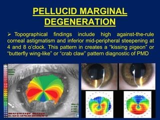 PELLUCID MARGINAL
DEGENERATION
 Topographical findings include high against-the-rule
corneal astigmatism and inferior mid-peripheral steepening at
4 and 8 o’clock. This pattern in creates a “kissing pigeon” or
“butterfly wing-like” or “crab claw” pattern diagnostic of PMD
 