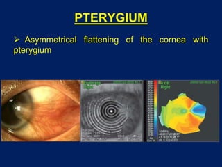 PTERYGIUM
 Asymmetrical flattening of the cornea with
pterygium
 
