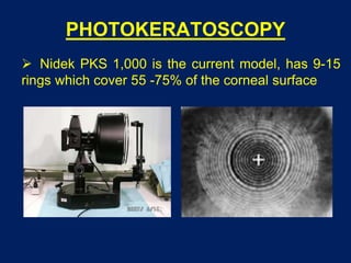 PHOTOKERATOSCOPY
 Nidek PKS 1,000 is the current model, has 9-15
rings which cover 55 -75% of the corneal surface
 