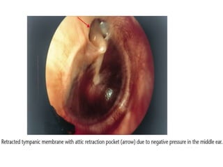 Cholesteatoma | PPTX