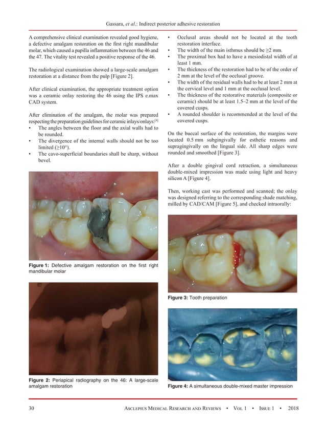 Indirect Posterior Adhesive Restoration Criteria to Success