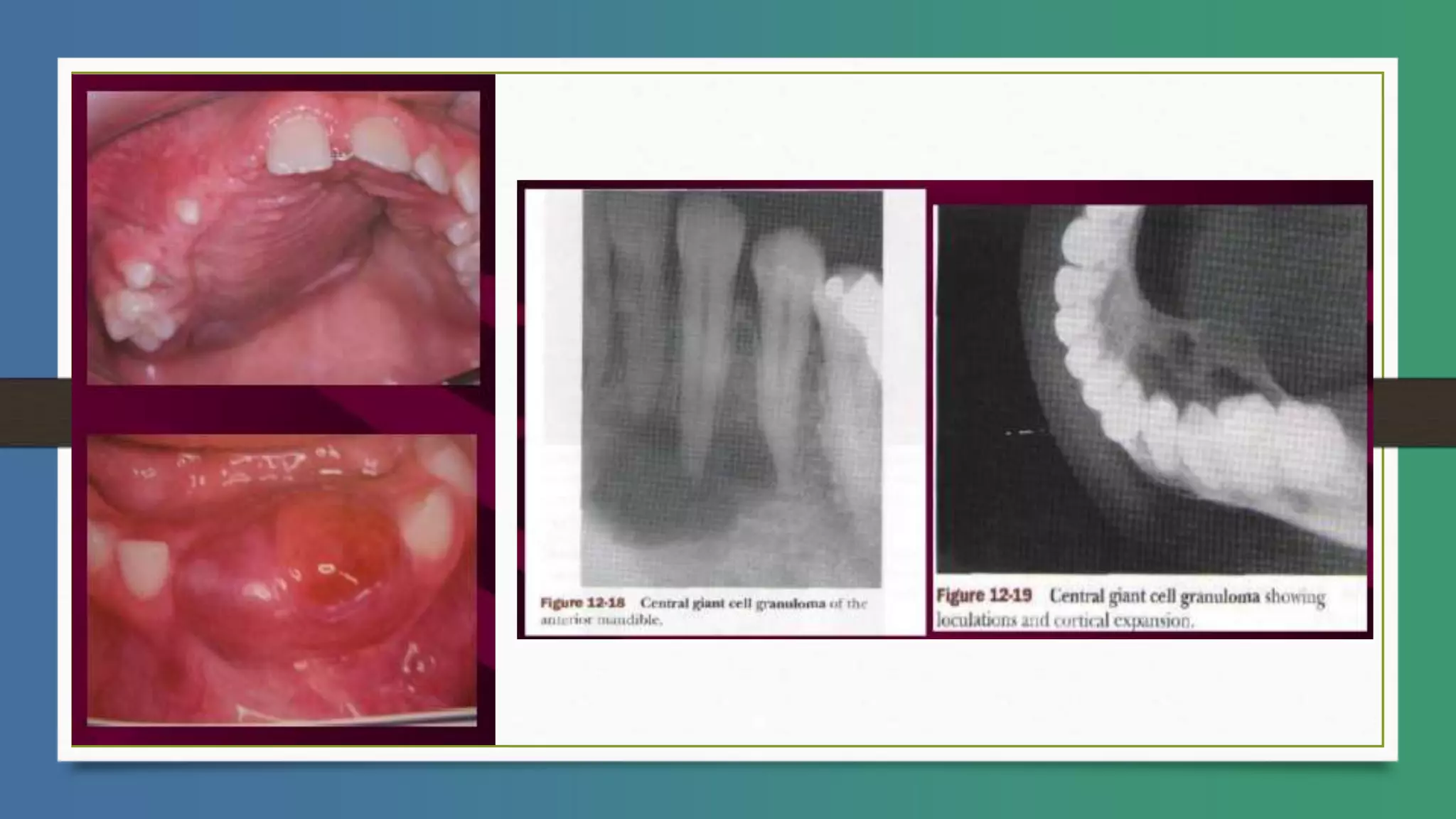 8.GIANT CELL LESIONS OF JAW.pptx