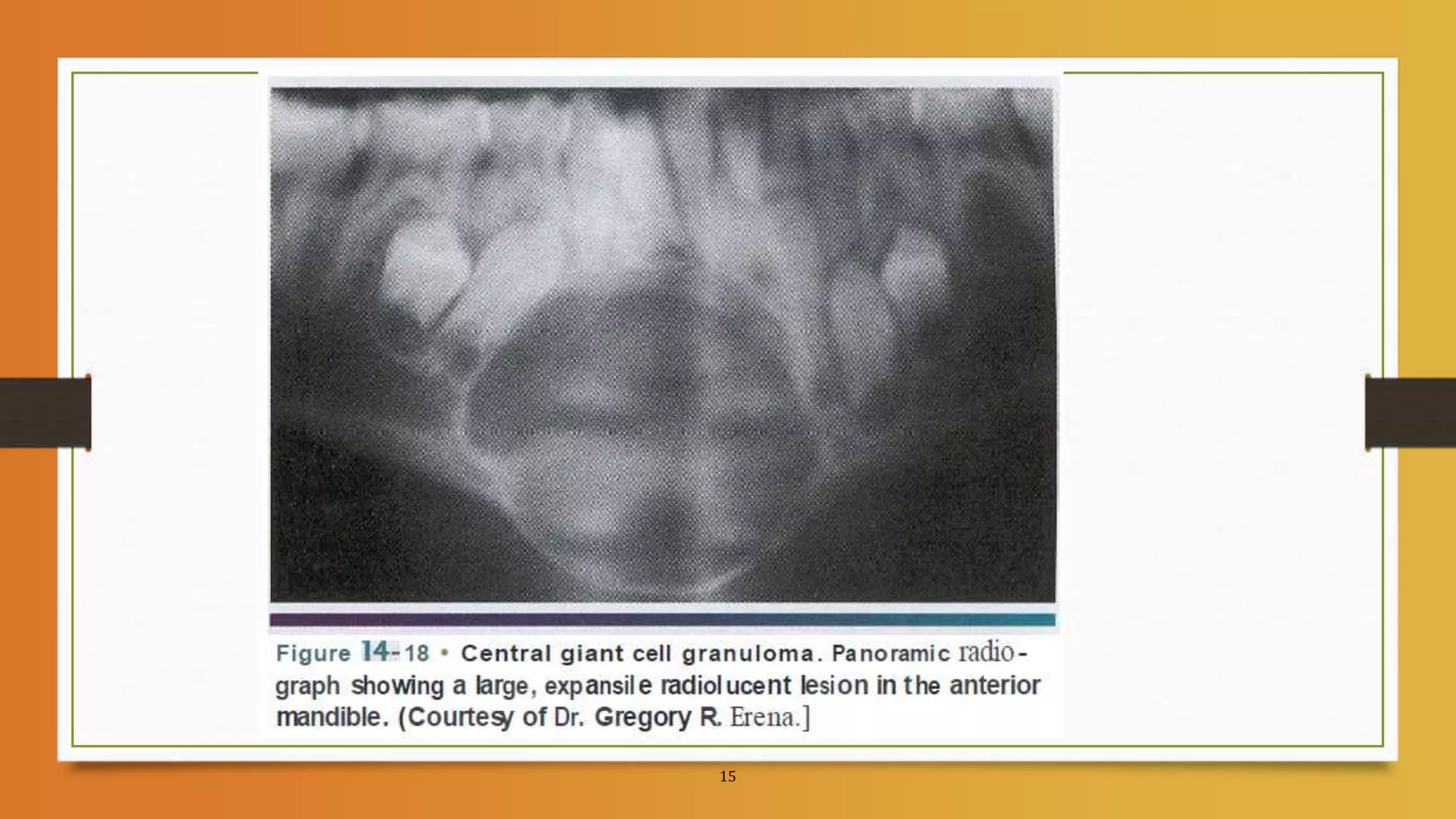 8.GIANT CELL LESIONS OF JAW.pptx