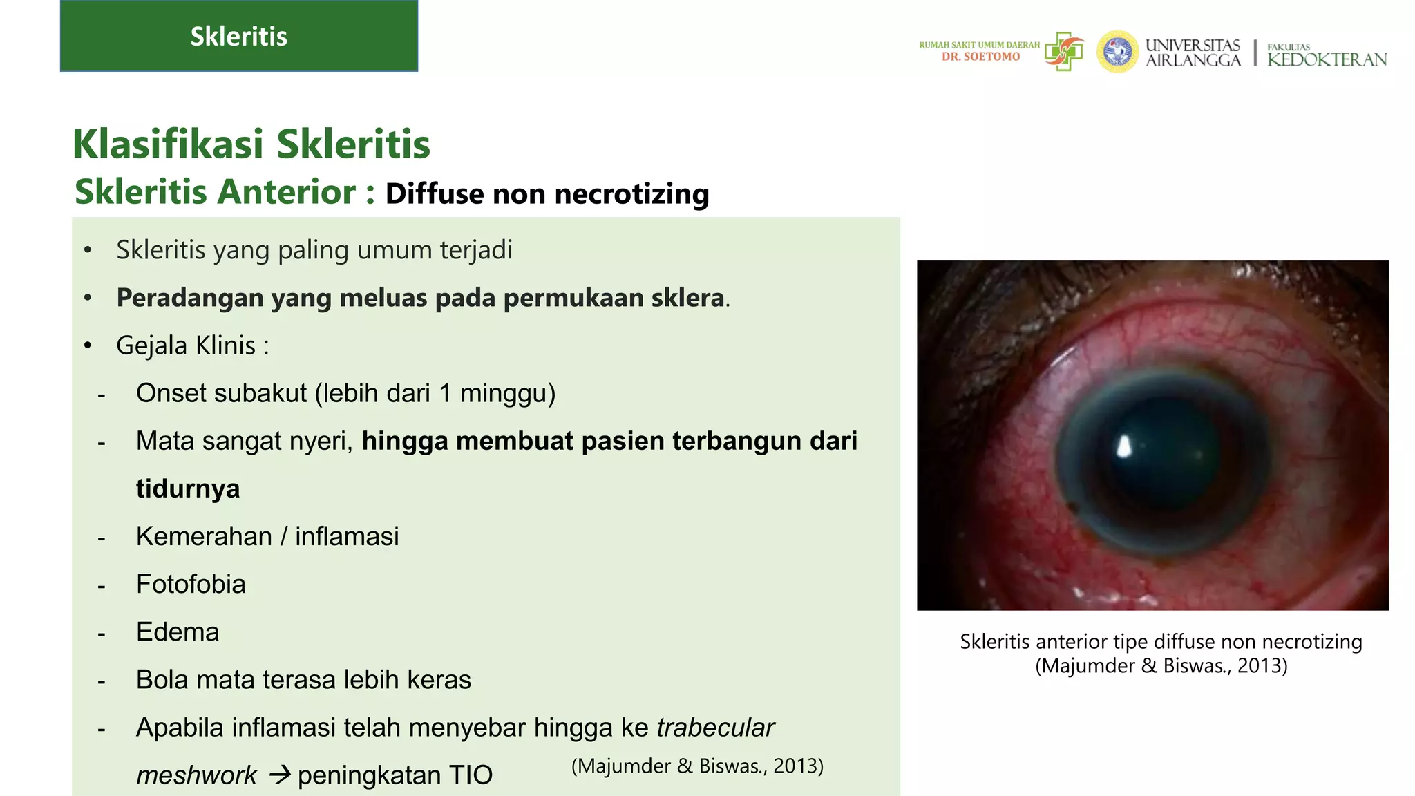 8. PPT Skleritis Episkleritis_Adinda Sandya P._011923143086.pptx