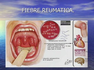 FIEBRE REUMATICA.
 
