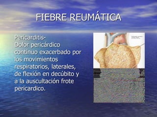 FIEBRE REUMÁTICA
Pericarditis-
Dolor pericárdico
continuo exacerbado por
los movimientos
respiratorios, laterales,
de flexión en decúbito y
a la auscultación frote
pericardico.
 