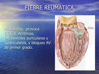 Miocarditis, provoca
I.C.C.V. Arritmias,
extrasístoles auriculares y
ventriculares, y bloqueo AV
de primer grado.
FIEBRE REUMÁTICA.
 