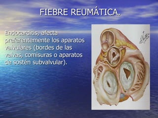 Endocarditis, afecta
preferentemente los aparatos
valvulares (bordes de las
valvas, comisuras o aparatos
de sostén subvalvular).
FIEBRE REUMÁTICA.
 