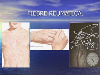 FIEBRE REUMATICA.
 