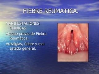 FIEBRE REUMATICA.
MANIFESTACIONES
CLINICAS
Ataque previo de Fiebre
Reumática.
Artralgias, fiebre y mal
estado general.
 