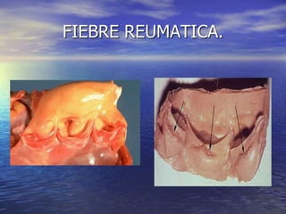 FIEBRE REUMATICA.
 