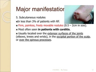 Major manifestations
5. Subcutaneous nodules
In less than 3% of patients with RF.
Firm, painless, freely movable nodules (0.5 – 2cm in size).
Most often seen in patients with carditis.
Usually located over the extensor surfaces of the joints
(elbows, knees and wrists), in the occipital portion of the scalp,
or over the spinous processes.
5/10/2023 By Tomas 11
 