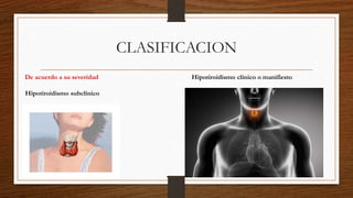 CLASIFICACION
De acuerdo a su severidad
Hipotiroidismo subclínico
Hipotiroidismo clínico o manifiesto
 
