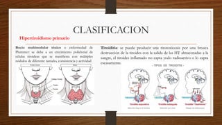 CLASIFICACION
Hipertiroidismo primario
Bocio multinodular tóxico o enfermedad de
Plummer: se debe a un crecimiento policlonal de
células tiroideas que se manifiesta con múltiples
nódulos de diferente tamaño, consistencia y actividad
Tiroiditis: se puede producir una tirotoxicosis por una brusca
destrucción de la tiroides con la salida de las HT almacenadas a la
sangre, el tiroides inflamado no capta yodo radioactivo o lo capta
escasamente.
 