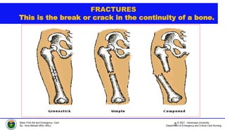 © 2021, Haramaya University
Department of Emergency and Critical Care Nursing
Basic First Aid and Emergency Care
By:- Ame Mehadi (BSc, MSc)
FRACTURES
This is the break or crack in the continuity of a bone.
5
 