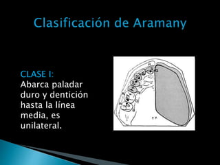 CLASE I:
Abarca paladar
duro y dentición
hasta la línea
media, es
unilateral.
 