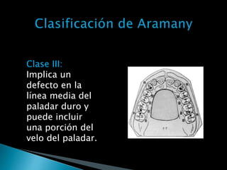 Clase III:
Implica un
defecto en la
línea media del
paladar duro y
puede incluir
una porción del
velo del paladar.
 