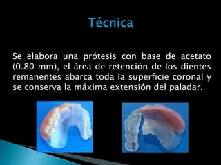 Se elabora una prótesis con base de acetato
(0.80 mm), el área de retención de los dientes
remanentes abarca toda la superficie coronal y
se conserva la máxima extensión del paladar.
 