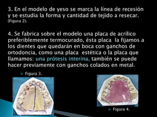3. En el modelo de yeso se marca la línea de recesión
y se estudia la forma y cantidad de tejido a resecar.
(Figura 2).
4. Se fabrica sobre el modelo una placa de acrílico
preferiblemente termocurado, ésta placa la fijamos a
los dientes que quedarán en boca con ganchos de
ortodoncia, como una placa estética o la placa que
llamamos: una prótesis interina, también se puede
hacer previamente con ganchos colados en metal.
 Figura 3.
 Figura 4.
 