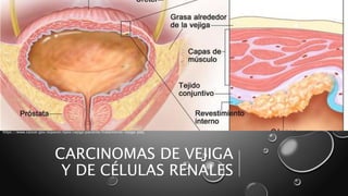 CARCINOMAS DE VEJIGA
Y DE CÉLULAS RENALES
https://www.cancer.gov/espanol/tipos/vejiga/paciente/tratamiento-vejiga-pdq
 