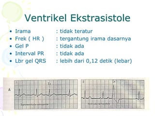 Ventrikel Ekstrasistole
• Irama : tidak teratur
• Frek ( HR ) : tergantung irama dasarnya
• Gel P : tidak ada
• Interval PR : tidak ada
• Lbr gel QRS : lebih dari 0,12 detik (lebar)
 