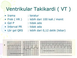Ventrikular Takikardi ( VT )
• Irama : teratur
• Frek ( HR ) : lebih dari 100 kali / menit
• Gel P : tidak ada
• Interval PR : tidak ada
• Lbr gel QRS : lebih dari 0,12 detik (lebar)
 