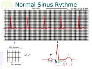 Normal Sinus Rythme
 
