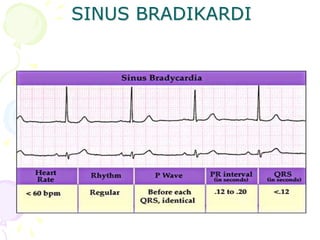 SINUS BRADIKARDI
 