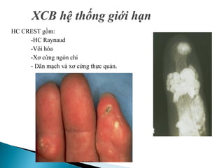 8. Xơ cứng bì.pdf rất hay và đặc sắc cực kỳ | PDF