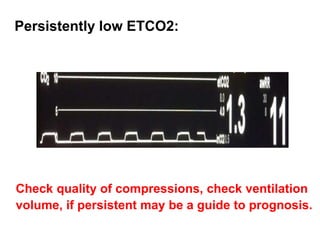 Persistently low ETCO2:
Check quality of compressions, check ventilation
volume, if persistent may be a guide to prognosis.
 