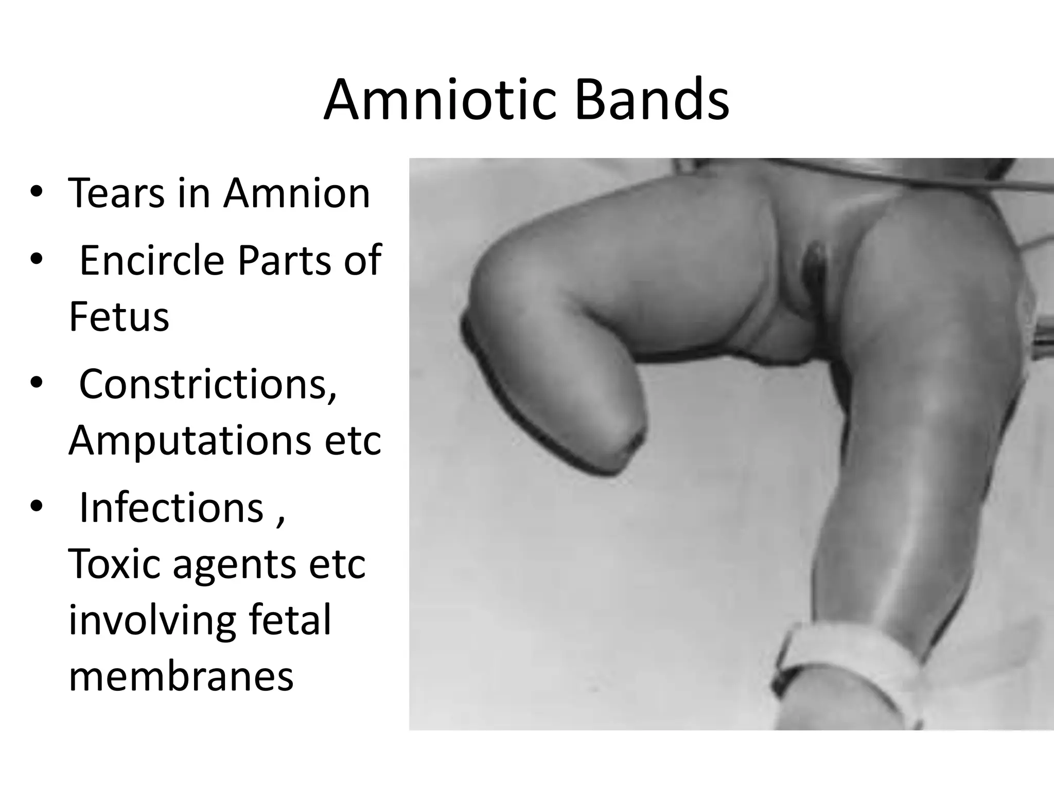 Amniotic Bands
• Tears in Amnion
• Encircle Parts of
Fetus
• Constrictions,
Amputations etc
• Infections ,
Toxic agents etc
involving fetal
membranes
 