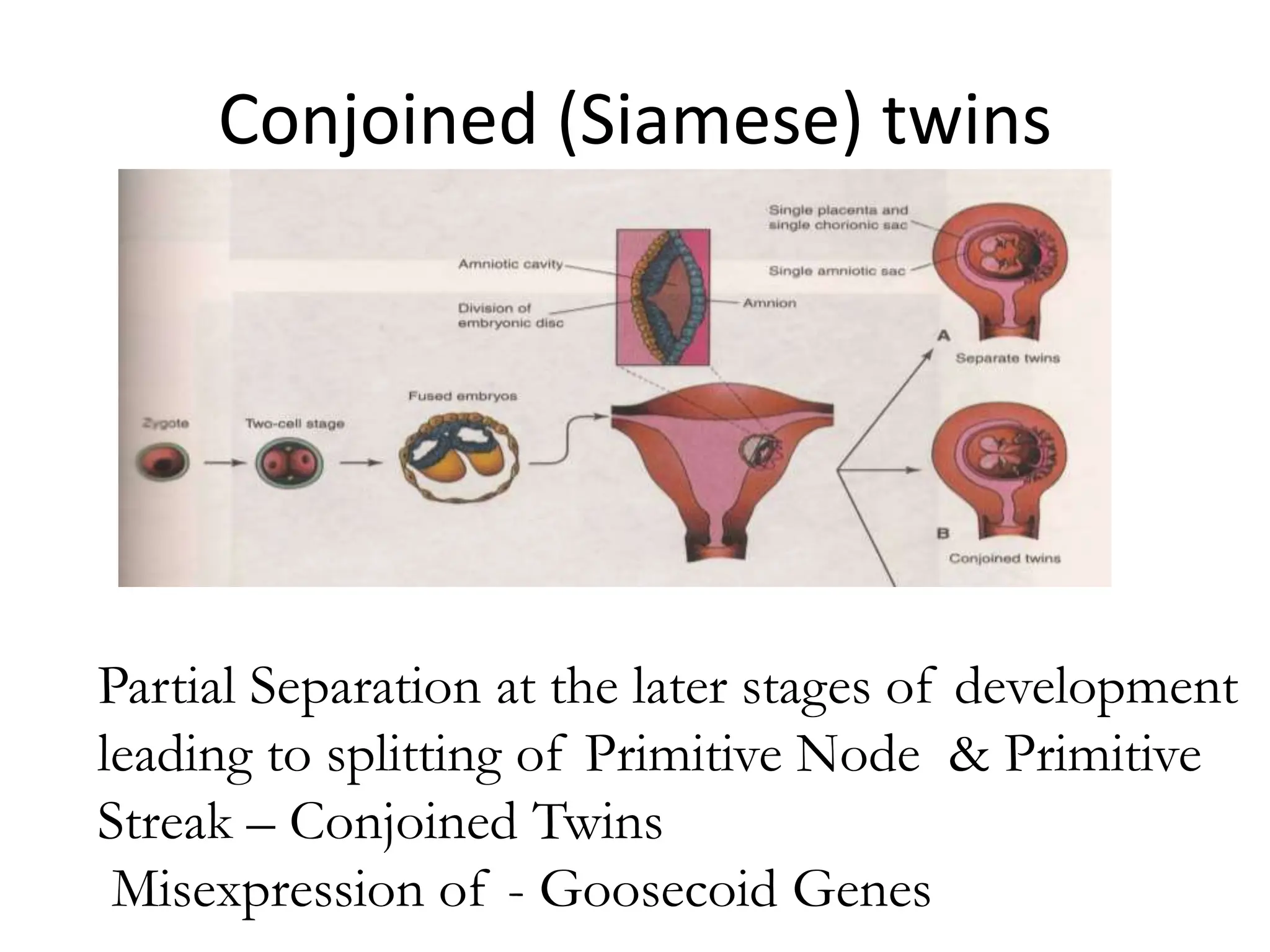 Conjoined (Siamese) twins
Partial Separation at the later stages of development
leading to splitting of Primitive Node & Primitive
Streak – Conjoined Twins
Misexpression of - Goosecoid Genes
 