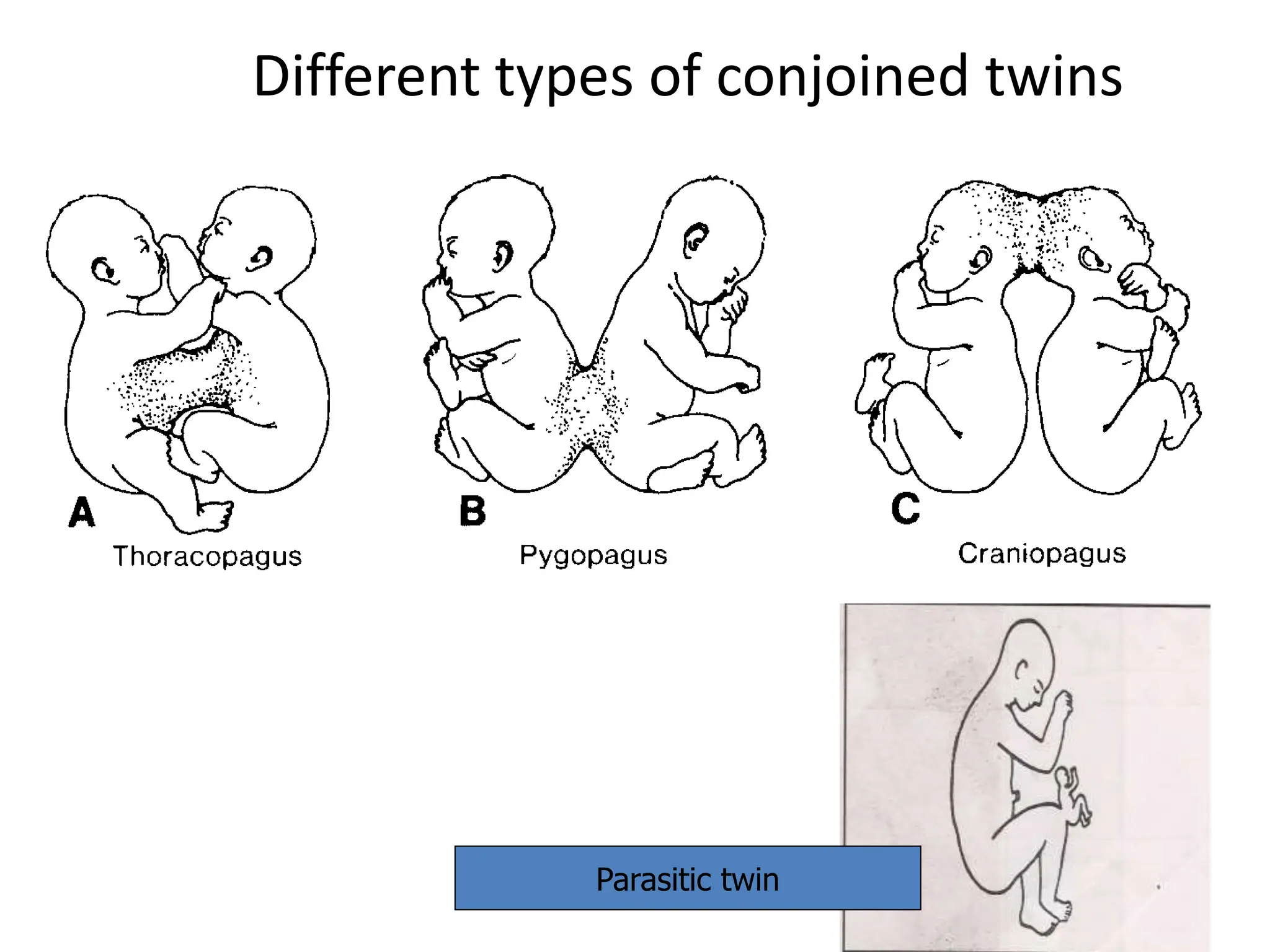 Different types of conjoined twins
Parasitic twin
 