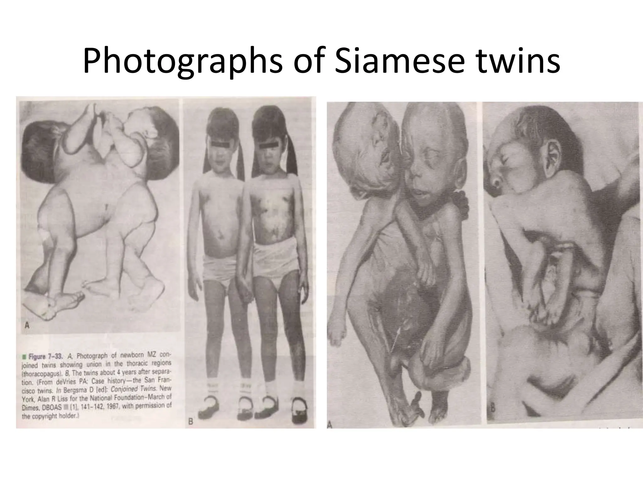 Photographs of Siamese twins
 