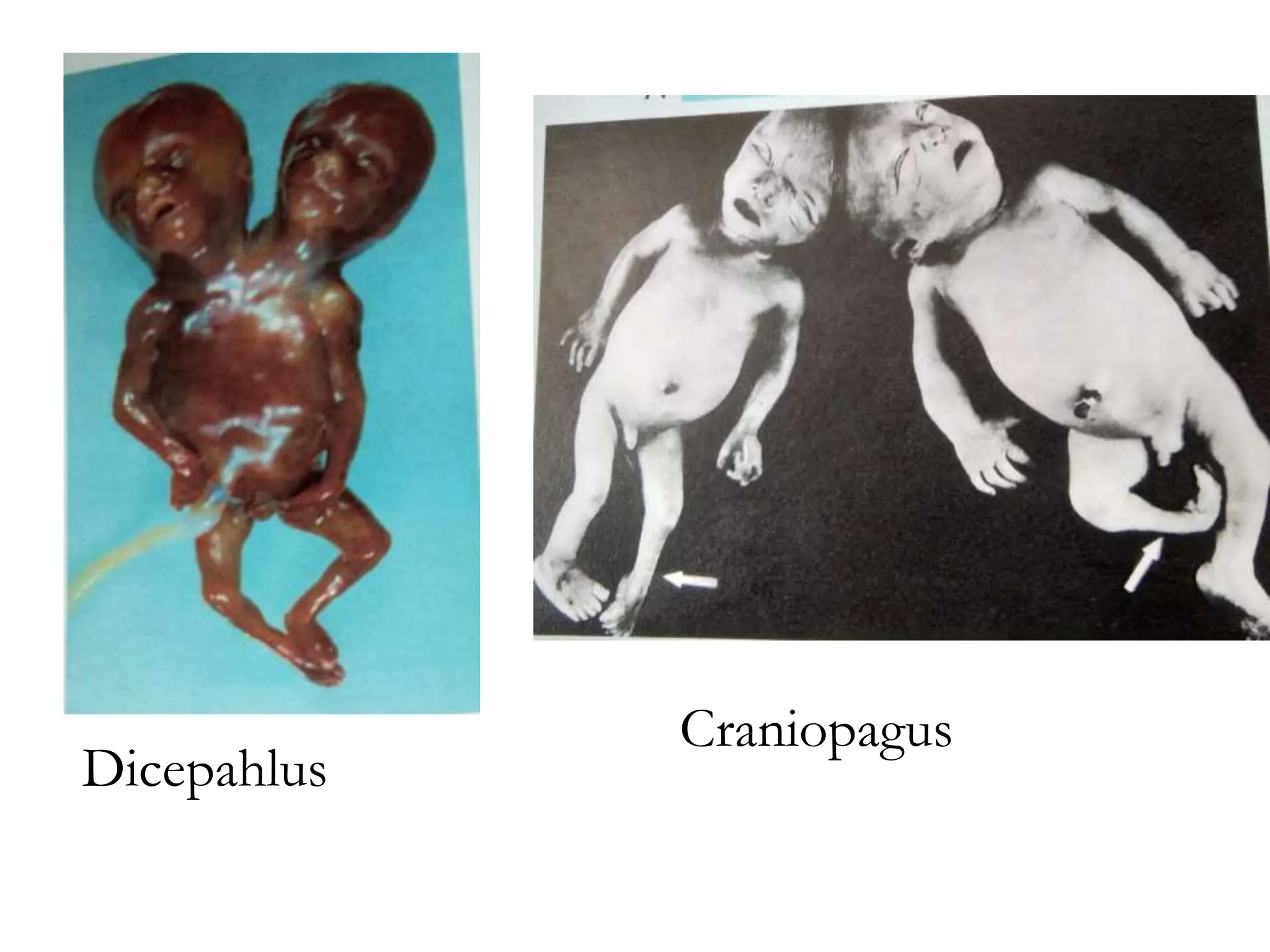 Dicepahlus
Craniopagus
 