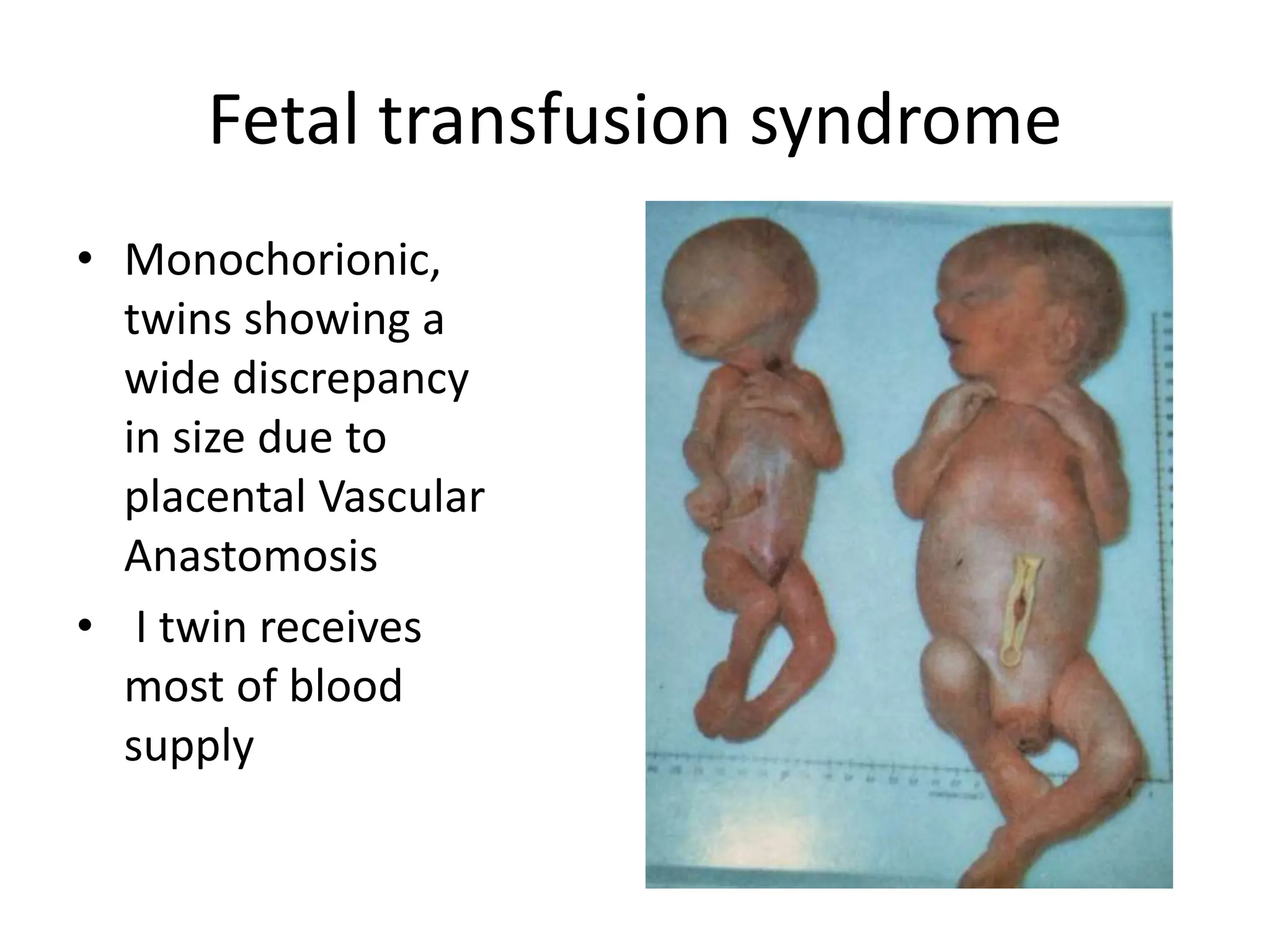 Fetal transfusion syndrome
• Monochorionic,
twins showing a
wide discrepancy
in size due to
placental Vascular
Anastomosis
• I twin receives
most of blood
supply
 