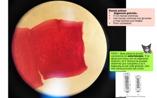 Taenia solium
• Segmento grávido.
• 7/12 ramas uterinas.
• Las ramas uterinas son gruesas
y más anchas que largas.
• Poro unilateral.
TIPP!!: Esta placa la ponen
usulmente en esteroscopio. Y al
igual que como con el segmento
maduro, la T. Solium la puedes
observar por completo y la T.
Saginata al ser más grande, sólo
ves cierta porción del corte.
 