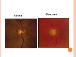 Chapter 1. GLAUCOMA lecture three3 .ppt