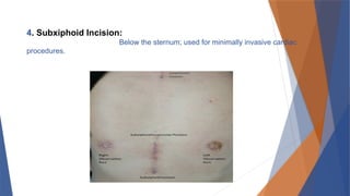 Paraxiphoid 8 .THORACIC SURGERY ( Cardiac Surgery) part 2..pptx