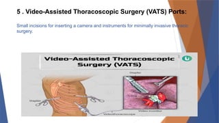 Vats Incision Scar 8 .THORACIC SURGERY ( Cardiac Surgery) part 2..pptx
