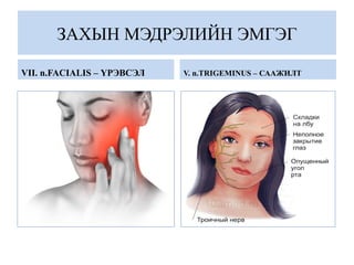 ЗАХЫН МЭДРЭЛИЙН ЭМГЭГ
VII. n.FACIALIS – ҮРЭВСЭЛ V. n.TRIGEMINUS – СААЖИЛТ
 