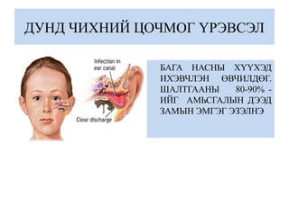 ДУНД ЧИХНИЙ ЦОЧМОГ ҮРЭВСЭЛ
БАГА НАСНЫ ХҮҮХЭД
ИХЭВЧЛЭН ӨВЧИЛДӨГ.
ШАЛТГААНЫ 80-90% -
ИЙГ АМЬСГАЛЫН ДЭЭД
ЗАМЫН ЭМГЭГ ЭЗЭЛНЭ
 