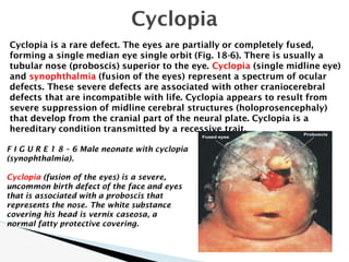 Cyclopia Child anatomy eyes from what you see .pdf