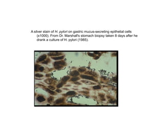 A silver stain of H. pylori on gastric mucus-secreting epithelial cells
(x1000). From Dr. Marshall's stomach biopsy taken 8 days after he
drank a culture of H. pylori (1985).
 