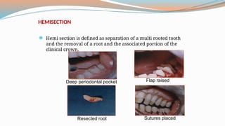 Tooth Hemisection 8-9- endodontic surgery - Endo perio relations1 and 2.pptx