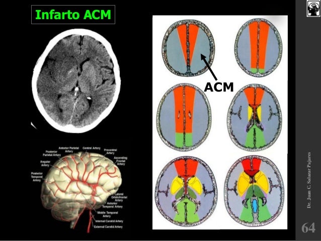 enfermedad cerebro vascular isquemica