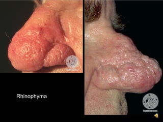 Rhinophyma
 