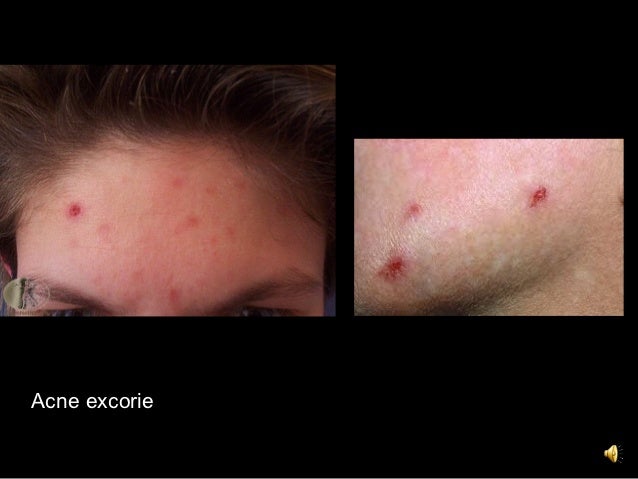 8. acne and rosacea 8. acne and rosacea