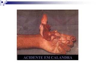 ACIDENTE EM CALANDRA 
 