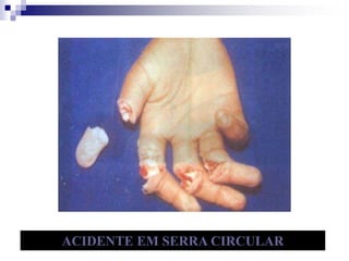 ACIDENTE EM SERRA CIRCULAR 
 